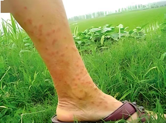 血吸虫 广东卫健委