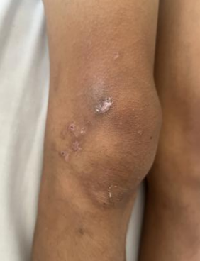 入院时小铭膝关节处皮损