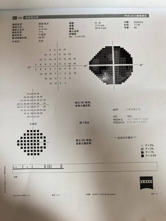 青光眼检查报告