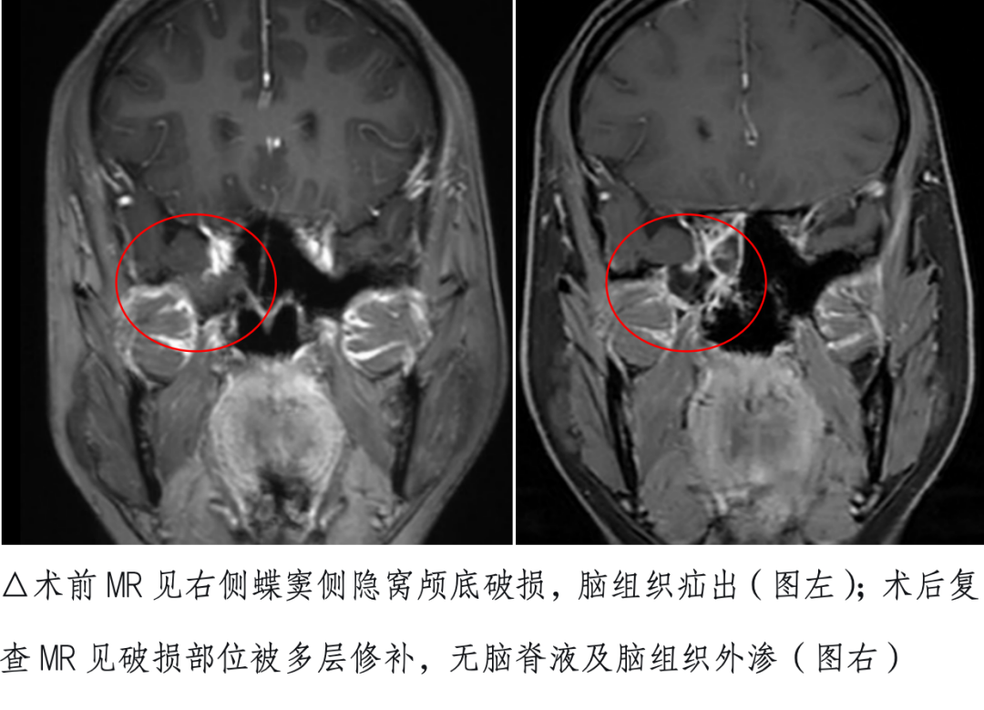 脑脊液鼻漏修补前后